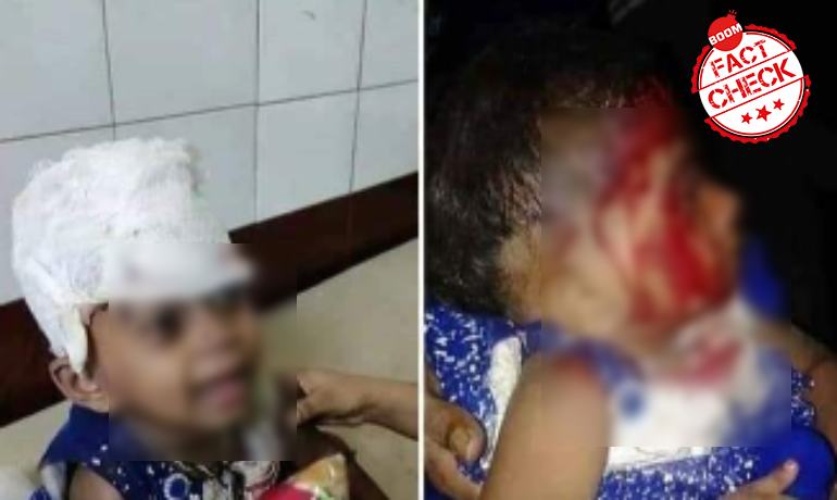 Photos Of Injured Child Are Not From Anti-CAA Protests In West Bengal Photos Of Injured Child Are Not From Anti-CAA Protests In West Bengal