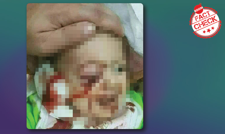 Injured Toddler Picture Not Linked To Citizenship Amendment Act Protests Injured Toddler Picture Not Linked To Citizenship Amendment Act Protests