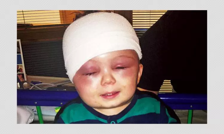 Did This Baby Have An Illness That Was Eating His Skull? A FactCheck.