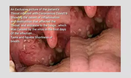 No, This Photo Does Not Show Throat Of Patient Infected With COVID-19