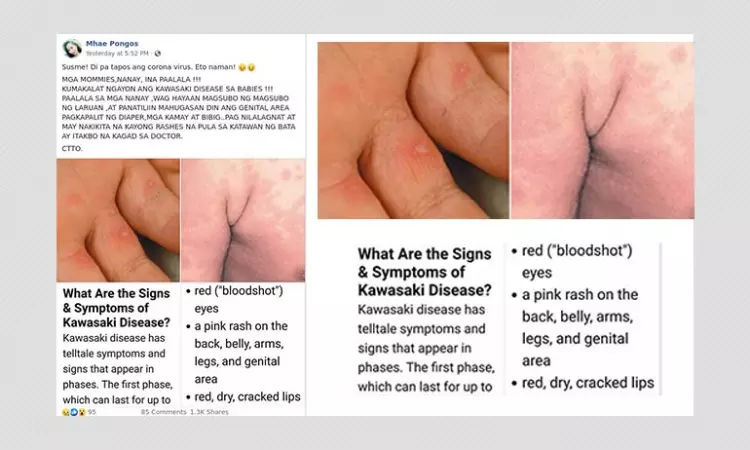 Are Babies Contracting Kawasaki Disease During The COVID-19 Pandemic?