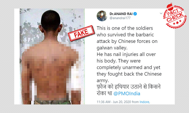 No, Photo Does Not Show Indian Soldier Injured In India-China Clash No, Photo Does Not Show Indian Soldier Injured In India-China Clash