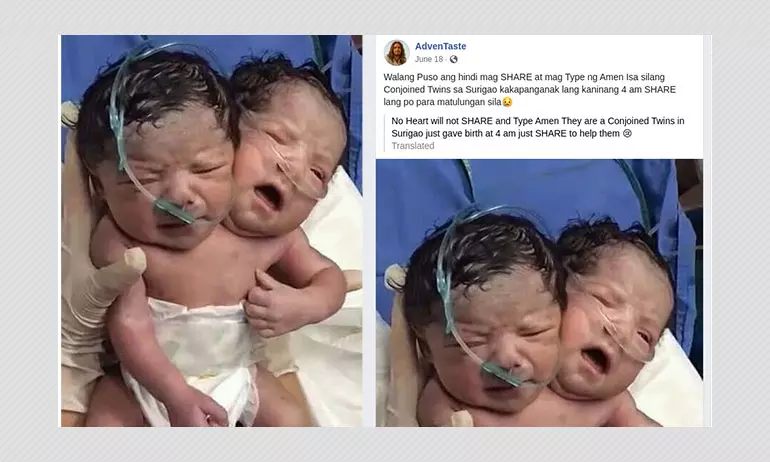 2017 Photo Of Conjoined Twins From Mexico Viral As Recent In Philippines