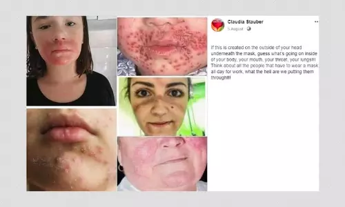 Read All Latest Updates On And About Eczema Herpeticum Read All Latest Updates On And About Eczema Herpeticum