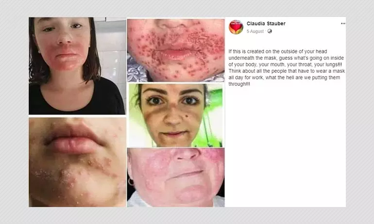 Photos Of Skin Conditions Shared As Effects Of Wearing Face Masks