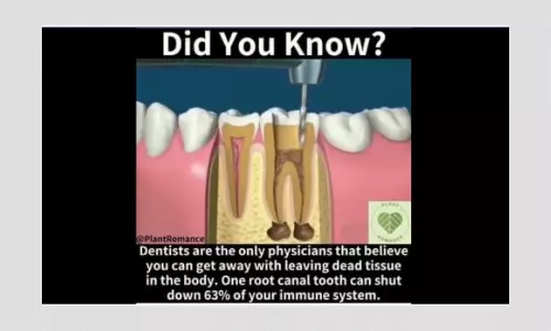 No, Root Canal Treatments Do Not Harm The Human Immune System