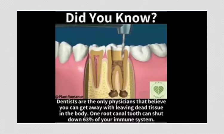 No, Root Canal Treatments Do Not Harm The Human Immune System