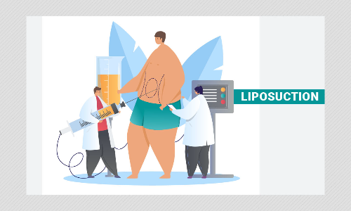 Explained: What Is Liposuction That Led To Actress Chethana Rajs Death