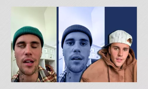 What is Ramsay Hunt Syndrome, The Condition Affecting Justin Bieber? What is Ramsay Hunt Syndrome, The Condition Affecting Justin Bieber?
