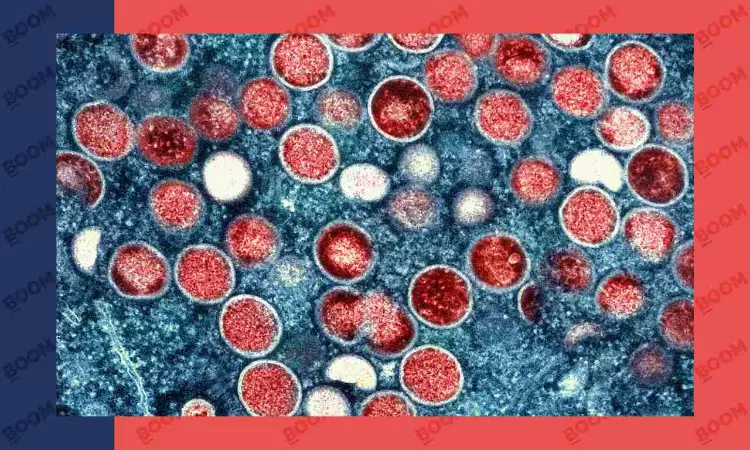 India Reports First Monkey Pox Case In Kerala: What Is It Really?