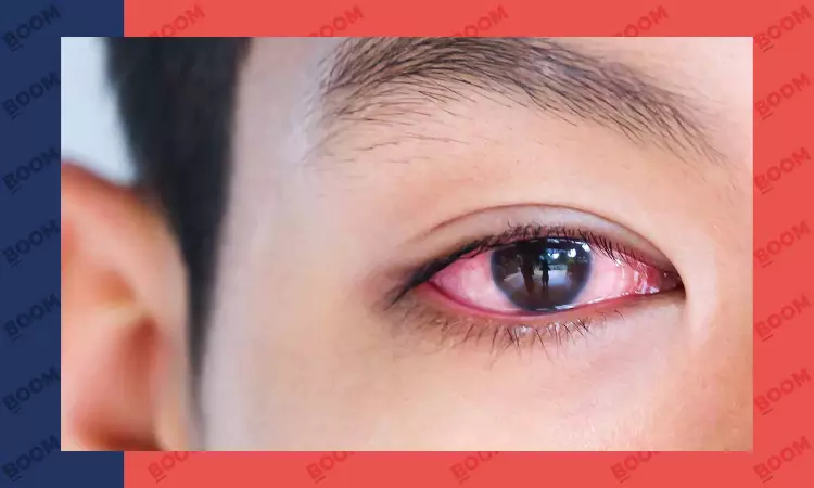Rising Conjunctivitis Cases in India: Causes and Precautions Explained