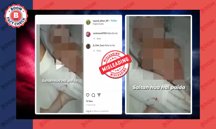 Video Of Newborn With Rare Skin Disorder Shared With False Claims